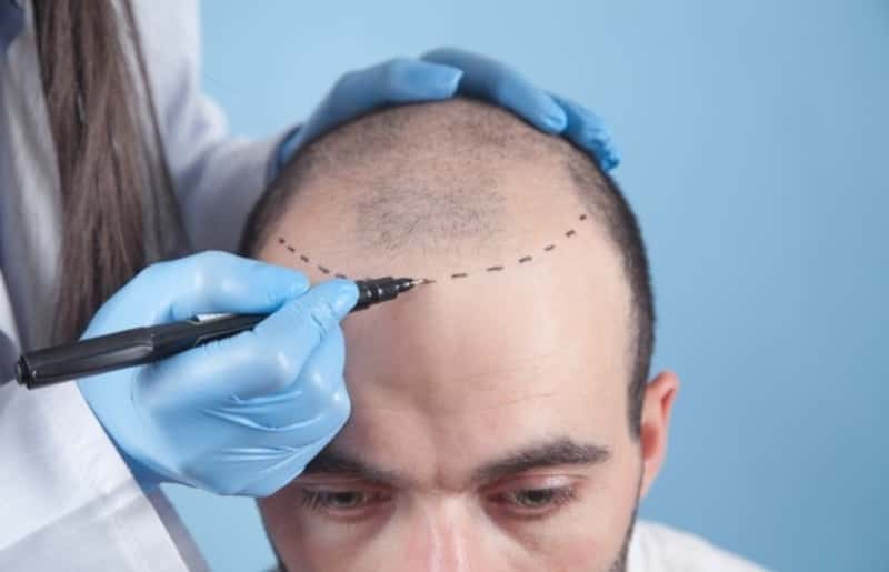 Hair Transplant क्या है इसके फायदे और नुकसान